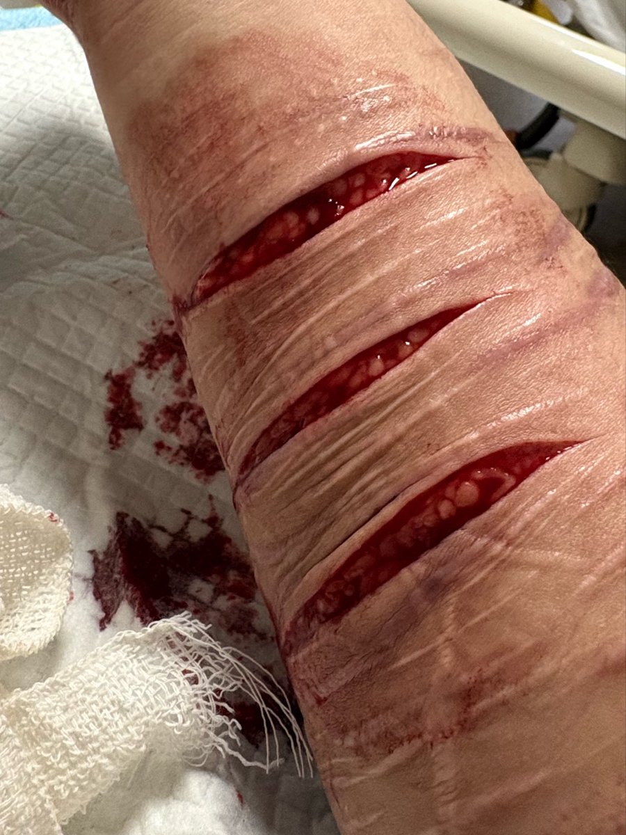 mp3loserye's tweet photo. (Repost) I fucking hate everything. The police was catching me and i tried to slit my wrist but because i was panicking i missed my wrist and IDK why i started slashing below FUCK #shtwt #beans #selfharm https://t.co/Ed9JuGwEsy