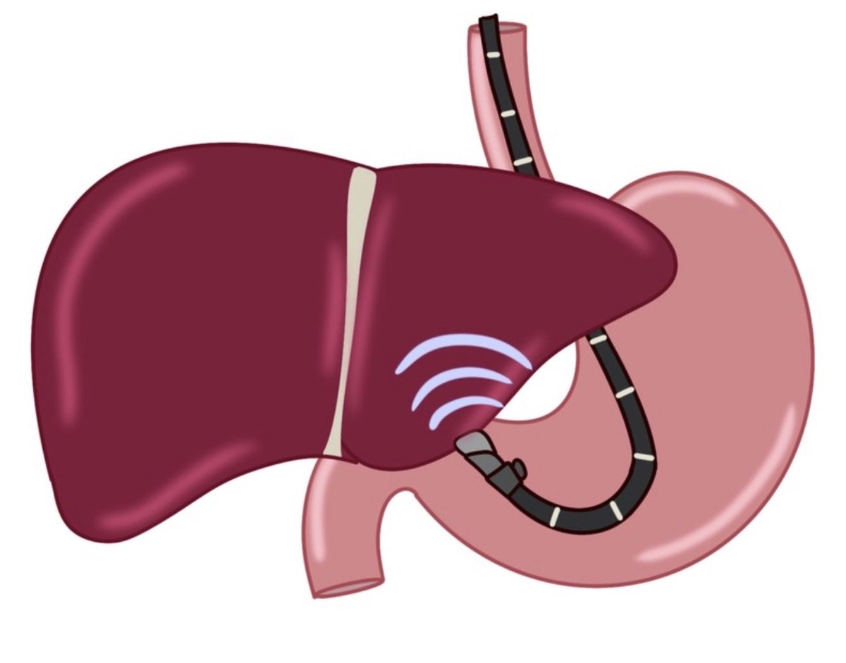 HepCommJournal's tweet photo. 🚨GI/Hep Fellowships start in 2️⃣ weeks‼️
@HepCommJournal has the 📑 you need to thrive 💫
#GIHepFellowshipBootcamp is back❕

First up, #Endohepatology
Learn EUS-guided:
Liver biopsy 💉 
Portal pressure 📏 
Variceal treatment 🩸 
Elastography
and more!

https://t.co/khvYbeNXd5 https://t.co/ZNLy6J4VYf