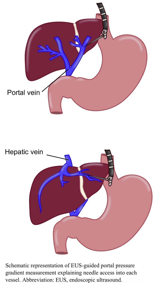 HepCommJournal's tweet photo. 🚨GI/Hep Fellowships start in 2️⃣ weeks‼️
@HepCommJournal has the 📑 you need to thrive 💫
#GIHepFellowshipBootcamp is back❕

First up, #Endohepatology
Learn EUS-guided:
Liver biopsy 💉 
Portal pressure 📏 
Variceal treatment 🩸 
Elastography
and more!

https://t.co/khvYbeNXd5 https://t.co/ZNLy6J4VYf