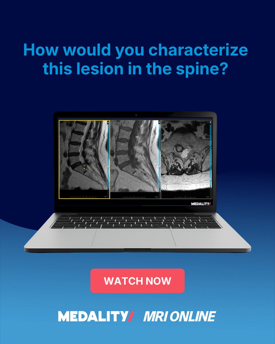 medalityhq's tweet photo. How would you characterize this lesion in the spine? The patient has a history of right S1 radiculopathy. Let us know your answer in the comments! 

Watch the case here: https://t.co/F5Hdl6vwuW https://t.co/TYJGjsTymq