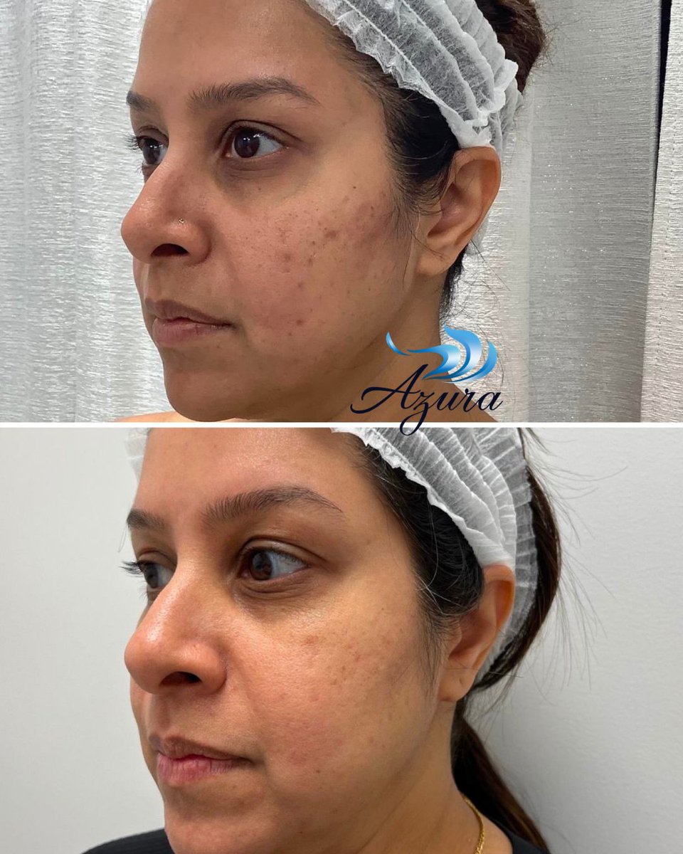 AzuraSkin's tweet photo. The ultimate summer laser... Yes, really! Unlike other lasers, MOXI® is safe for all skin types, all year round—even during the sunny summer months. 

Click here: https://t.co/qRo7PRAYnQ to see how it targets sun damage, uneven texture, and pigmentation with minimal downtime. https://t.co/1IGP2iXgNq