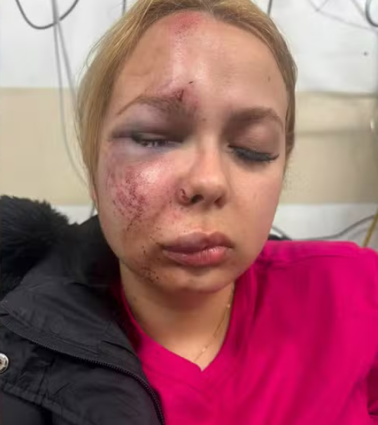 republiqueBRA's tweet photo. 🚺 💥 Jovem de 24 anos tem o maxilar, o joelho esquerdo, o nariz e três dentes quebrados após ser agredida por morador de rua em estação de metrô em São Paulo (SP); o caso foi registrado como lesão corporal, mas a mulher afirma ter sido alvo de uma tentativa de feminicídio. https://t.co/lq9pwgNIcv