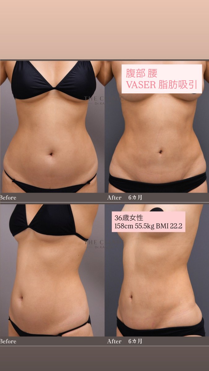 katokztheclinic's tweet photo. 158cm・55.5kg（BMI22前後）。

実はこのくらいの体型の腹部脂肪吸引は、かなり難易度が高い部類です。

「お腹が気になる」という方は多く、
実際に施術を受けている方も少なくありません。

それなのに、この体型の症例写真は意外と見かけません。あっても、真横だけだったり、寝た状態、術直後だけだったり。

理由はシンプル。
写真映えしにくいからです。

BMI30近い方では、吸引量を増やしやすく、変化も写真で伝わりやすい。
一方、BMI22前後では、少し細くなっても写真では伝わりにくいことがあります。

それでも、手術の難易度はむしろ高くなります。

取りすぎれば、凹凸や皮膚のたるみ、やつれ感につながる。
逆に、残しすぎれば、「思ったより変わらない」という結果に。

「どれだけ脂肪を取るか」ではありません。
どこを残し、どこを取るか。

そのバランスが、仕上がりを大きく左右します。
この体型は”簡単そうに見えて難しい”腹部脂肪吸引なのです。

[写真: ベイザー脂肪吸引, 吸引脂肪量: 2,200ml, 術後 1.8kgの体重増加があります]