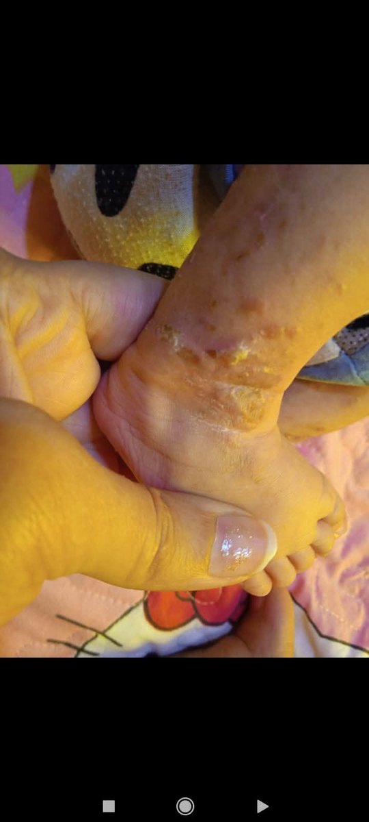 Rozana_0l's tweet photo. Scabies has spread all over my child's body I am worried about my baby girl 😥😭

 Donate even $10

https://t.co/Jlkqw56KSG https://t.co/iavtHfyXpQ