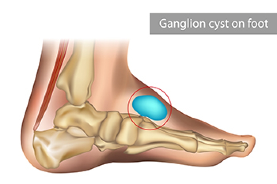 afcdallastx's tweet photo. Understanding Ganglion Cysts https://t.co/15H1MtK3CD https://t.co/hKENP5eURv