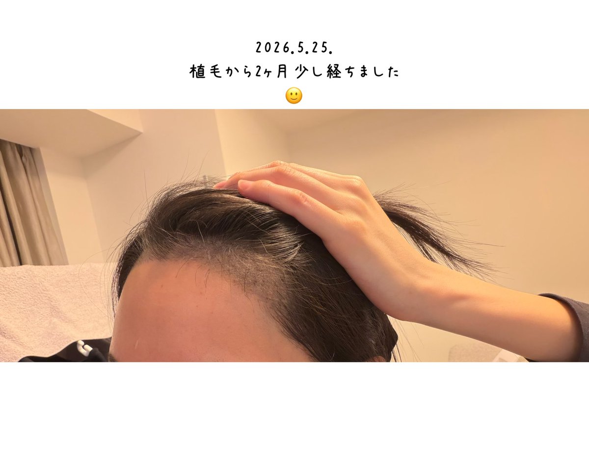 0c__73's tweet photo. 植毛をしてからの経過レポ
1年といった長期のダウンタイムになるから不安にもなりますが、様子見です🙂⸝⋆ https://t.co/W1jgXH0pIc