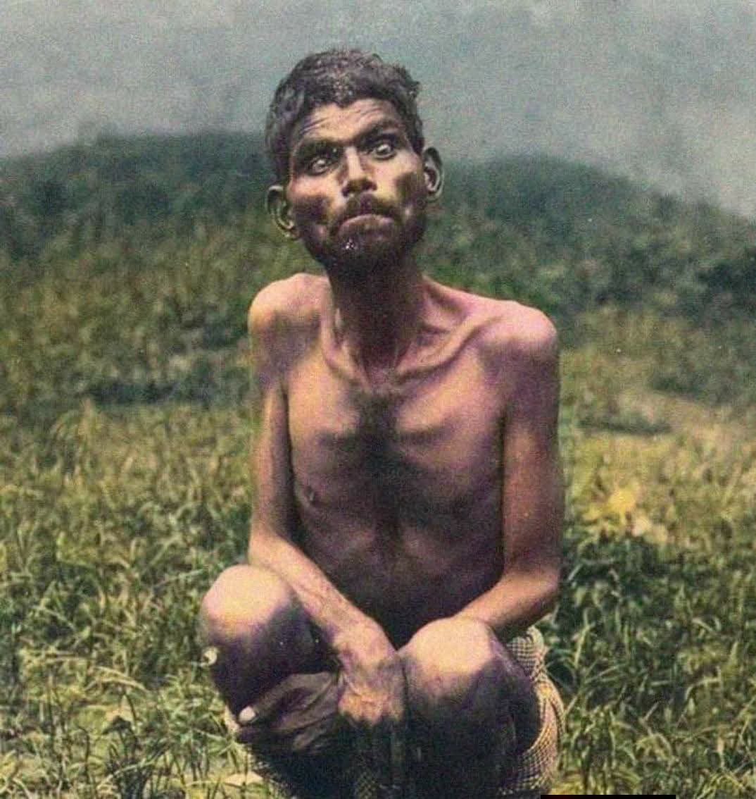 archeohistories's tweet photo. Found in 1867 inside a jungle cave, this feral boy named Dina Sanichar, preferred eating raw meat, had trouble standing on two feet, growled like a wolf, and gnawed on bones to sharpen his teeth. He never learned to speak, and became the inspiration for The Jungle Book's character of Mowgli.

Dina Sanichar is one of the most famous, and tragic, cases of a so-called "feral child."

The boy was reportedly discovered in 1867 by hunters near Bulandshahr in northern India and was said to be living among wolves. He was taken to the Sikandra Mission Orphanage near Agra, where missionaries named him Dina Sanichar. "Sanichar" means Saturday, the day he arrived.

Accounts from the orphanage describe a child who walked on all fours, preferred raw meat, showed little interest in human interaction, and never developed spoken language despite years of effort. Over time he learned some human behaviors, such as wearing clothes and using utensils, but he never acquired normal speech.

His story became important to scientists studying language development. Cases like Sanichar's helped support the idea that there may be a critical period in childhood during which humans are best able to learn language. Once that window passes, acquiring language becomes dramatically more difficult.

Many writers have connected Sanichar's story to The Jungle Book, published by Rudyard Kipling in 1894. While there is no evidence that Mowgli was directly based on Sanichar, the parallels between a boy raised by wolves and Kipling's famous character are striking.

Sanichar eventually developed a strong addiction to tobacco after observing others smoking at the orphanage. He died in 1895, likely from tuberculosis, at about age 34. His life remains one of the most frequently cited examples in discussions of human development, language acquisition, and the effects of extreme social isolation.

© Reddit

#archaeohistories
