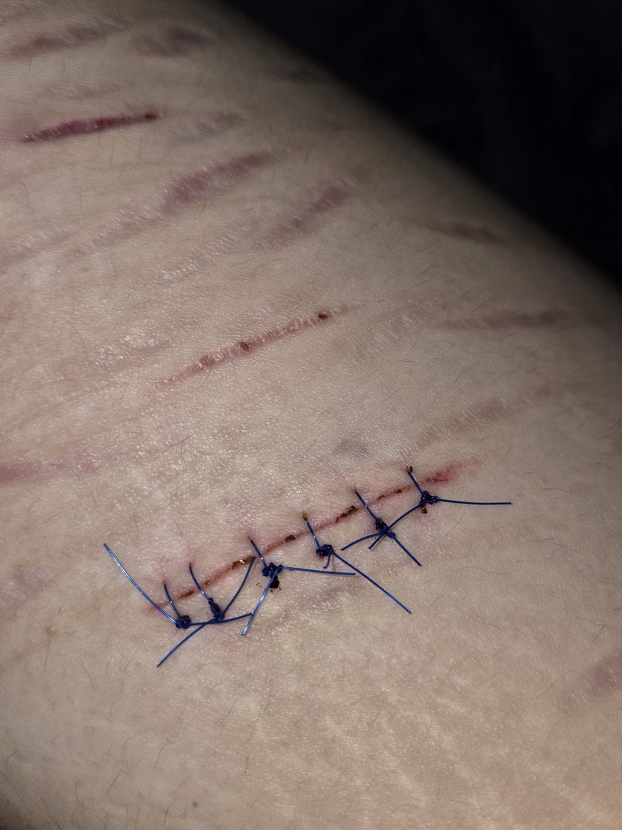 nothingbby4's tweet photo. these two pictures are from today. the first is how the dr left the stitches in, all the knots are on the same side. two of the stitches have moved so the knot is on the other side of the cut, is that normal? are they supposed to move around like that? its also become super itchy https://t.co/N3S8gMh5Gg