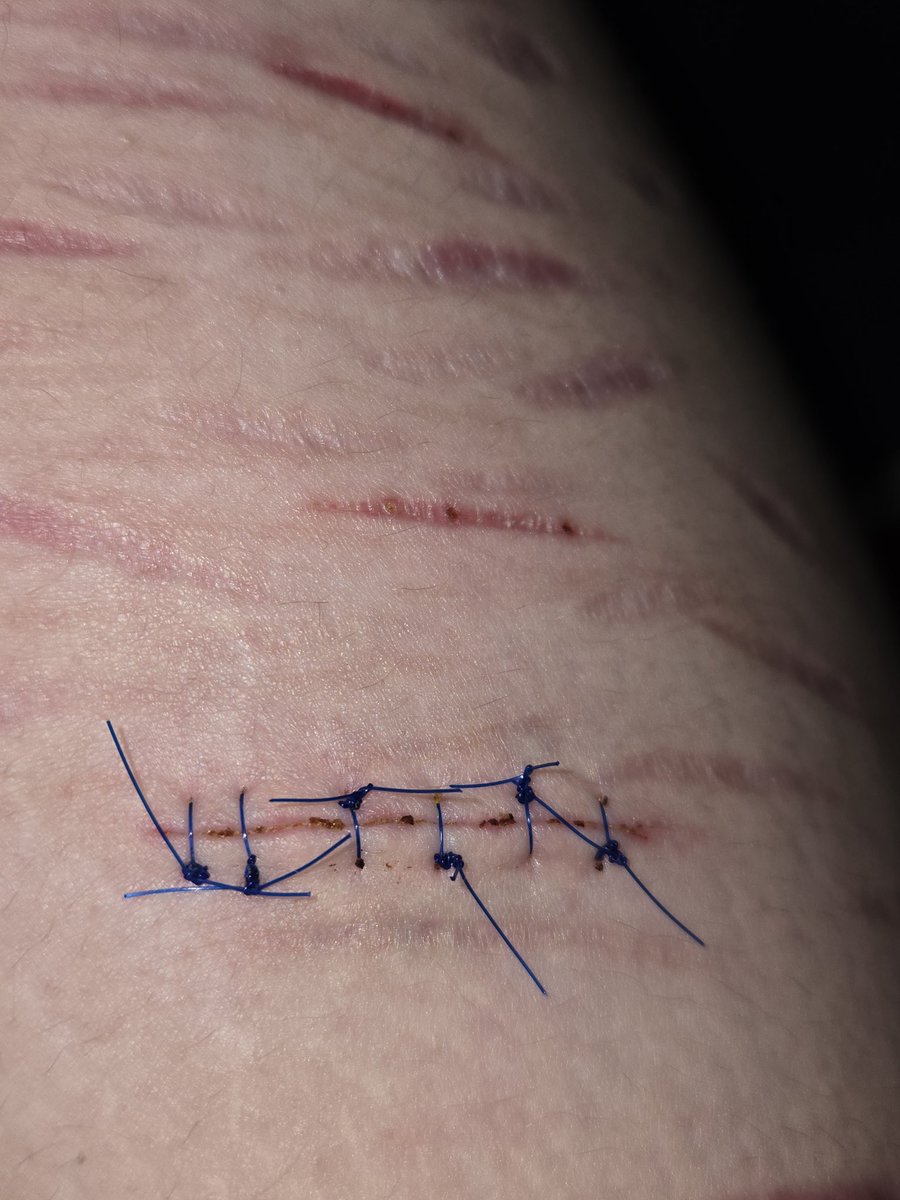 nothingbby4's tweet photo. these two pictures are from today. the first is how the dr left the stitches in, all the knots are on the same side. two of the stitches have moved so the knot is on the other side of the cut, is that normal? are they supposed to move around like that? its also become super itchy https://t.co/N3S8gMh5Gg