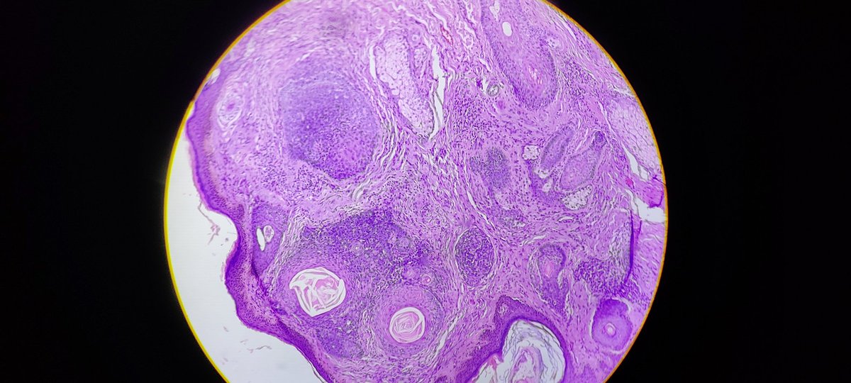 MunchManju95's tweet photo. Middle age male with nodular lession in face for six months... Your observations and diagnosis???
#learnpathologywithmanju
@ManjulaNavamani
#dermatopath #pathresidents #pathquiz #histopathdiagnosis https://t.co/oFH4BPndO4
