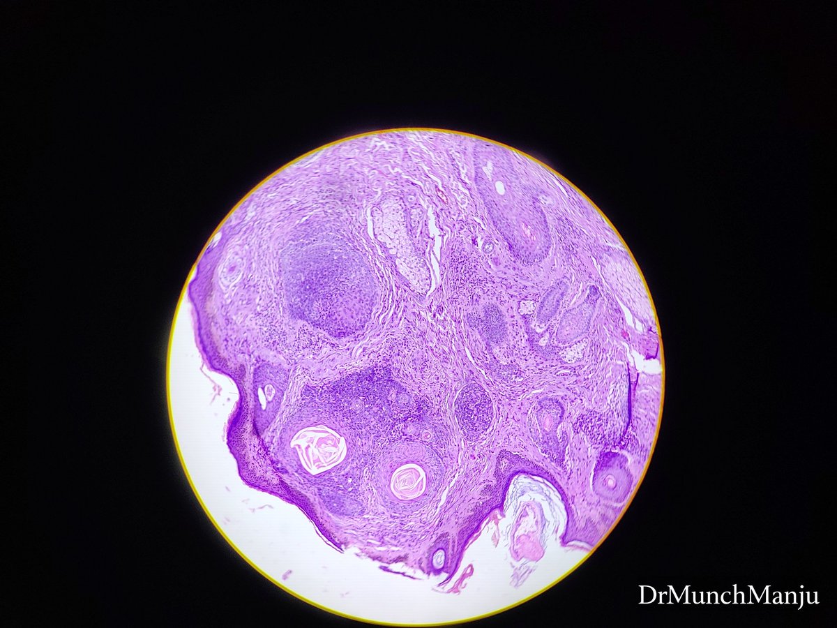 MunchManju95's tweet photo. Middle age male with nodular lession in face for six months... Your observations and diagnosis???
#learnpathologywithmanju
@ManjulaNavamani
#dermatopath #pathresidents #pathquiz #histopathdiagnosis https://t.co/oFH4BPndO4