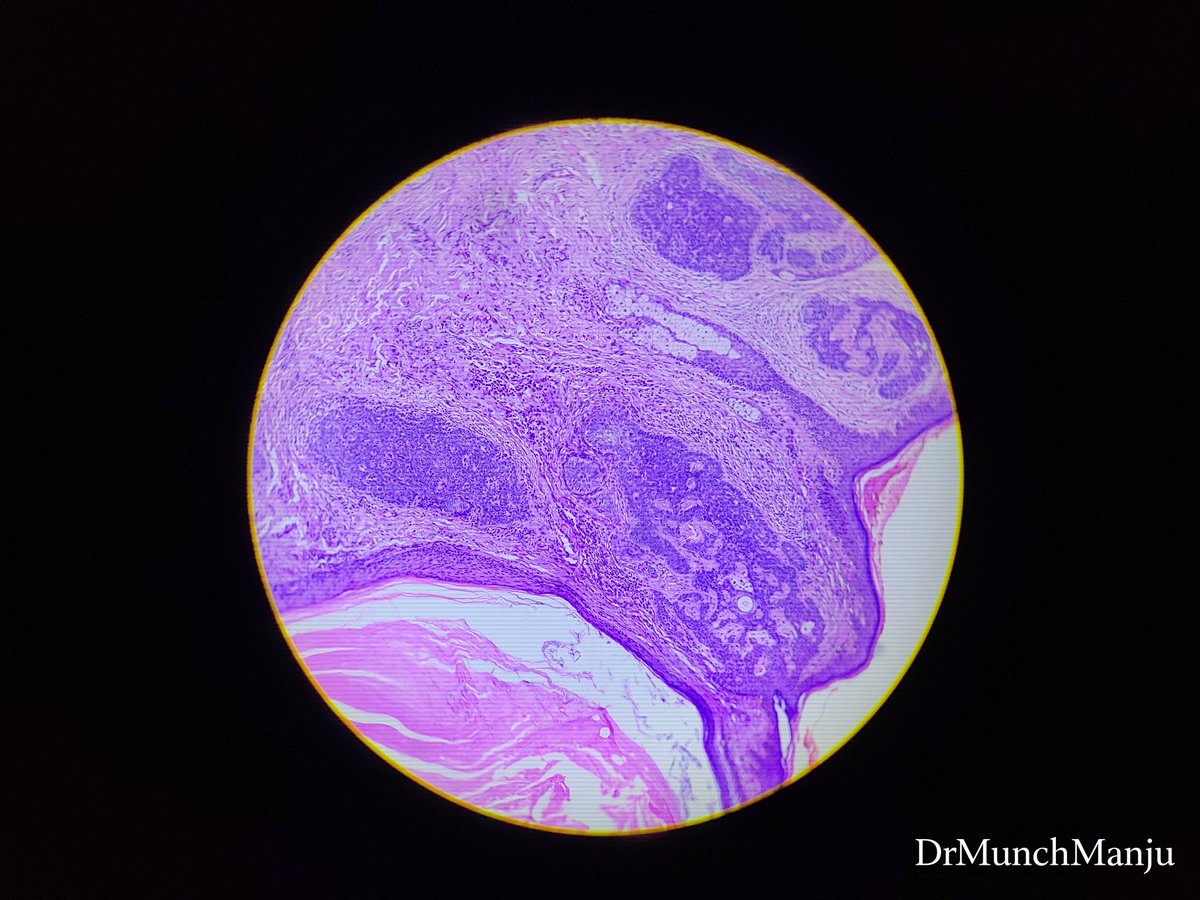 MunchManju95's tweet photo. Middle age male with nodular lession in face for six months... Your observations and diagnosis???
#learnpathologywithmanju
@ManjulaNavamani
#dermatopath #pathresidents #pathquiz #histopathdiagnosis https://t.co/oFH4BPndO4