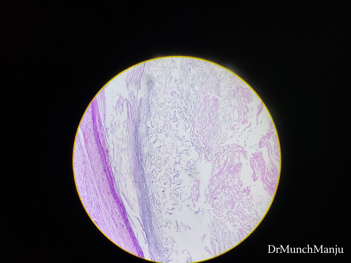 MunchManju95's tweet photo. Middle age male with nodular lession in face for six months... Your observations and diagnosis???
#learnpathologywithmanju
@ManjulaNavamani
#dermatopath #pathresidents #pathquiz #histopathdiagnosis https://t.co/oFH4BPndO4