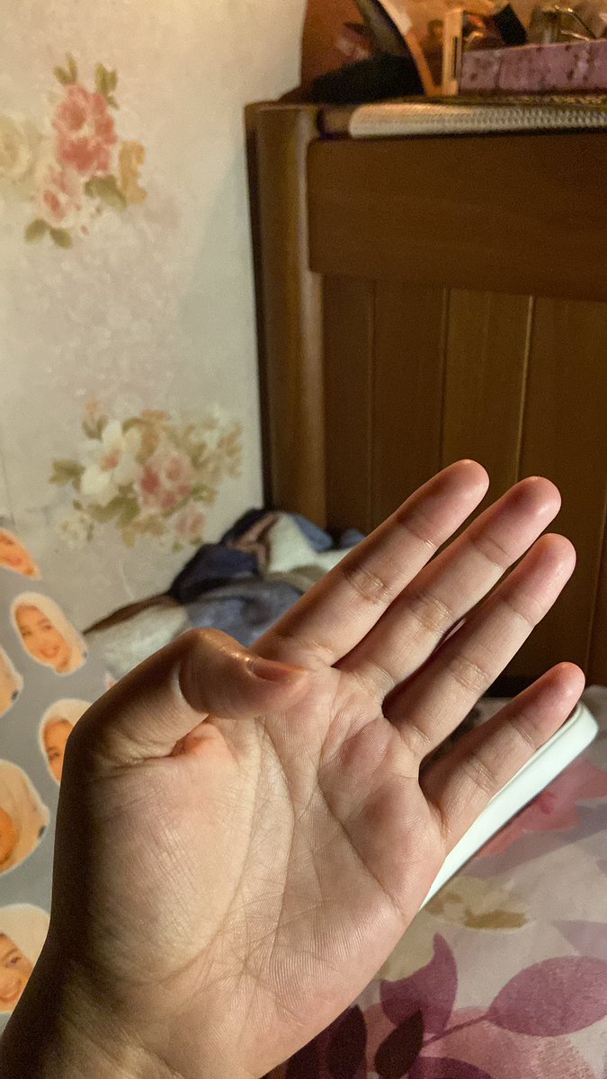 prideuxfir's tweet photo. posisi jempol udh nekuk gabisa balik kaya gini tetep dirujuk sesuai slot dokternya, dpt slot JULI tf?! sampe juli gue cuma dikasih pain killer tiap harinya udh gilakkk https://t.co/bJI9uz66eX