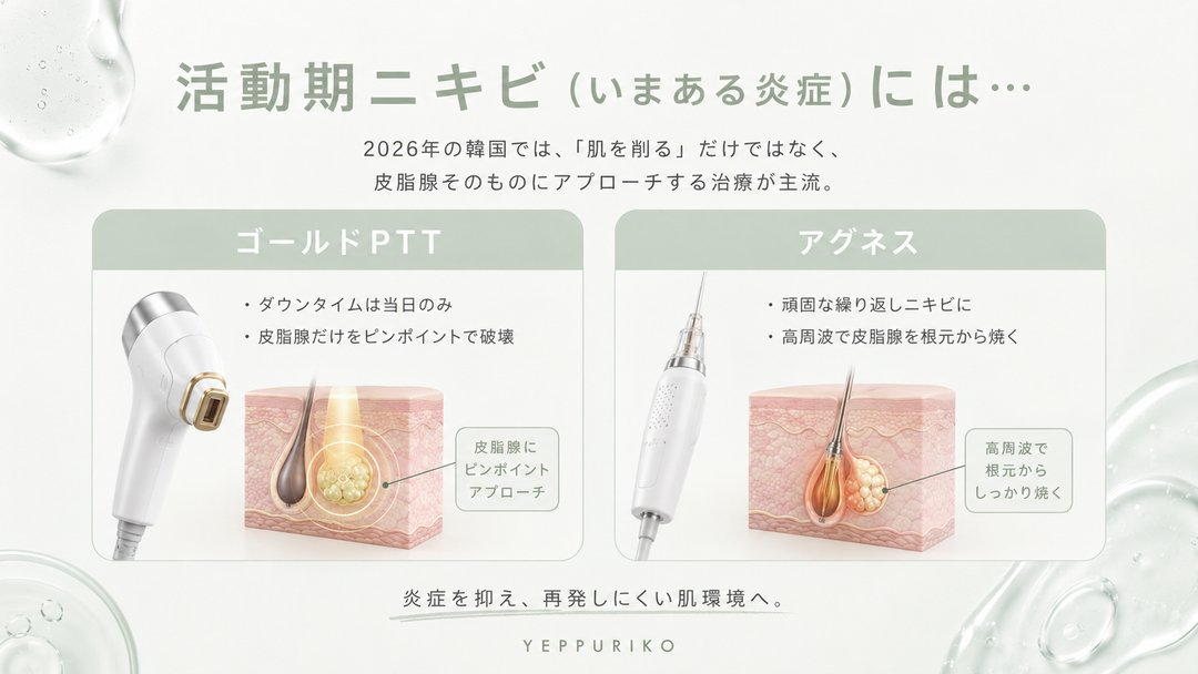 yeppuriko's tweet photo. 「ニキビ、何度治しても同じ場所に戻ってくる…」
それ、皮脂腺が残ったままだから。

2026年の韓国では、もう「肌を削る」だけの時代は終わっています。
最新トレンドは、皮脂腺そのものを根本から壊して、コラーゲンで内側から再生させる組み合わせ治療。

✨ 活動期ニキビ（いまある炎症）には…
🔸 ゴールドPTT：ダウンタイムは当日のみ。皮脂腺だけをピンポイントで破壊
🔸 アグネス：頑固な繰り返しニキビに。高周波で皮脂腺を根元から焼く

✨ ニキビ跡・クレーター・毛穴には…
🔹 ポテンツァ ＋ ジュベルック：コラーゲンを自力で作らせ、凹みを内側からふっくら押し上げる（ダウンタイム2〜4日）
🔹 ミラジェット ＋ ジュベルック：針なし・痛み少なめの最新トレンド。赤みも1〜2日程度と短め

施術後は、オリーブヤングでEGF・PDRN配合のシカクリームをゲットして厚塗り＆UV対策が必須。ここで差がつきます。

自分の肌が「活動期」か「跡の段階」か、まず見極めることが近道。
こういった最新情報をこれからも発信していくので、気になった方はぜひフォローして保存しておいてください🌿