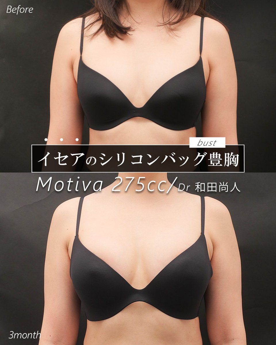 isea_case's tweet photo. 豊胸
シリコンバック豊胸　275cc
執刀医：和田 尚人

Before：術前
After：3か月後

■豊胸サイト
https://t.co/1ELNR98zIF

■豊胸Instagram
https://t.co/jqXwwDNrWI

■和田尚人Instagram
https://t.co/XZNUnneHke

■リスク・副作用
腫れ・内出血・血種・感染

■料金
Motivaバッグプロテーゼ豊胸　¥935,000(税込)
全身麻酔　¥110,000(税込)
圧迫サポーター　¥2,200(税込)