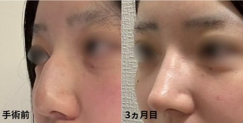 mt6ew3's tweet photo. 経過観察 3ヶ月目⤵️
腫れや痛みは全くなく、日常生活も問題なく過ごせています。
術前と比べると、鼻筋が整い、横顔のラインが綺麗になったと感じています。
まだ完成までは時間がかかるとのことなので、今後さらに馴染んでいくのが楽しみです！
現時点でも自然な仕上がりで満足しています🥹
 #鼻フル https://t.co/8b55iupRBl