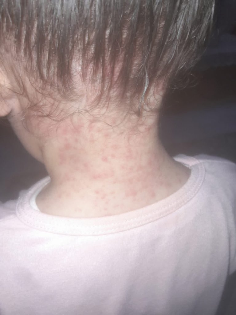 Dr_SaebGaza's tweet photo. SCABIES HAS SPREAD ALL OVER MY CHILD’S BODY. I AM WORRIED ABOUT MY BABY GIRL. 😥😭

PLEASE DONATE, EVEN $10 CAN HELP. 🙏🏻💔

https://t.co/CdhPnbXDnd https://t.co/jWzUS5f6Yw