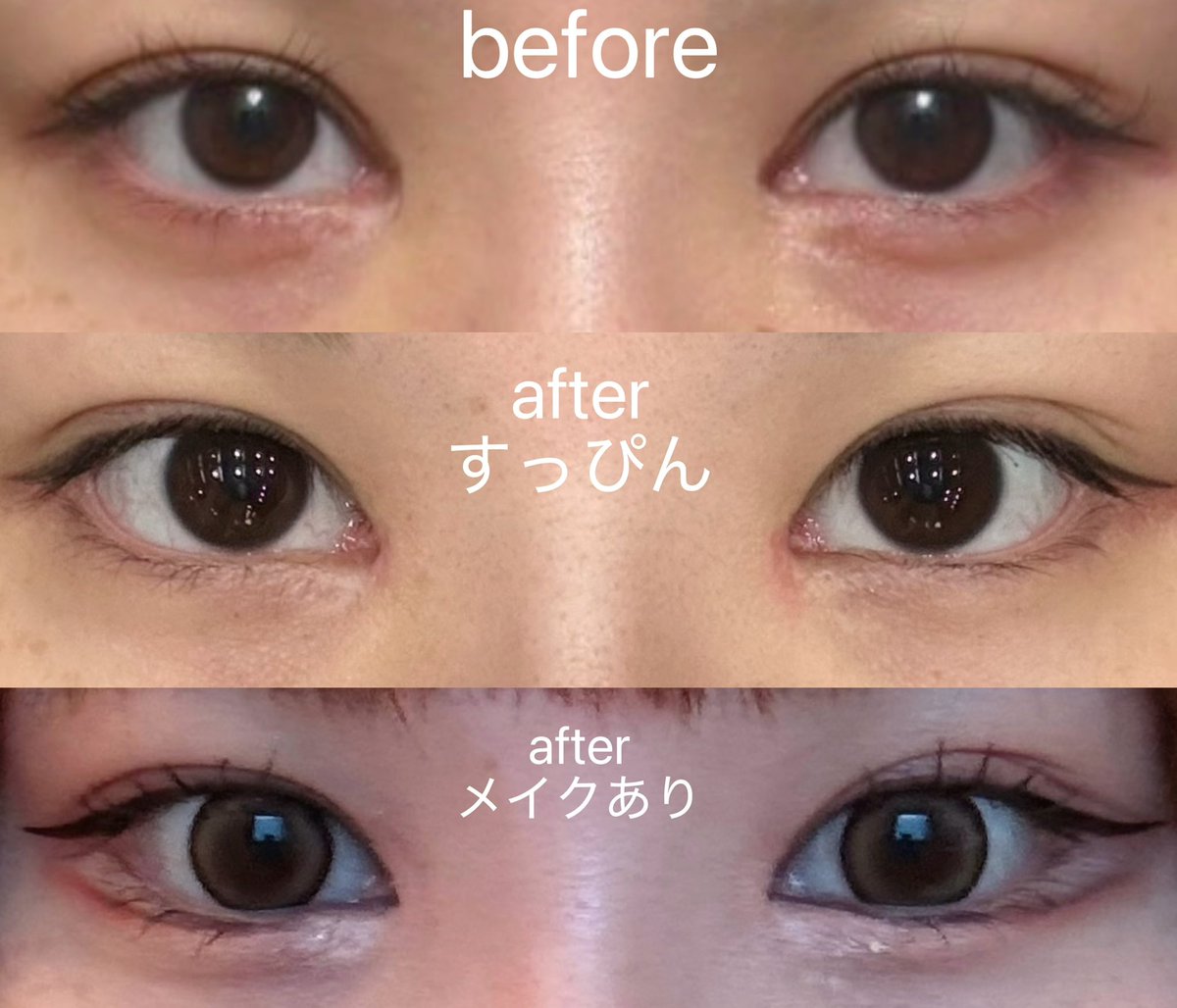 Ar0LMtD8n495296's tweet photo. 術後3ヶ月です！
すっぴんの時はまだ目頭少し赤いけど誰かに指摘されたことはないです🙂‍↕️
目の下の脂肪移植の効果もあってクマも改善されたし、整形バレることなく自然に変われて満足です https://t.co/yLOAYbopXC
