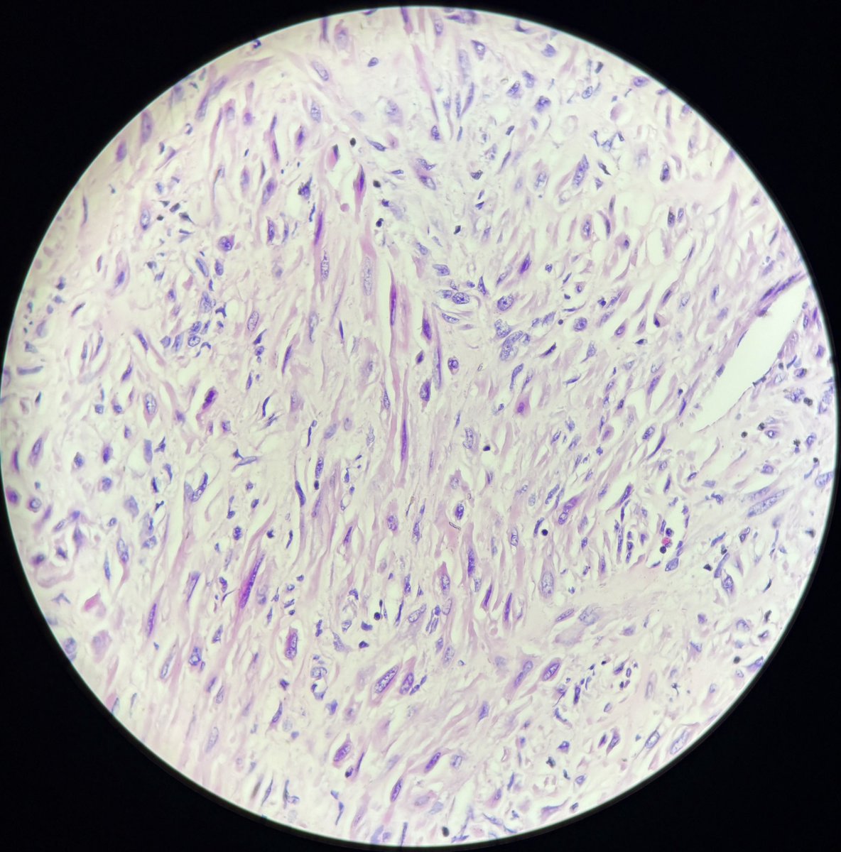 sripath25's tweet photo. Symplastic leiomyoma/ leiomyoma with bizarre nuclei 
☄️hyperchromatic pleomorphic nuclei , easily appreciated in low power. 
☄️ mitoses < 4/10 HPF. 
☄️no coagulative type tumor necrosis. 
#pathology #pathologyoutlines #histology https://t.co/9T6rTFiS1V