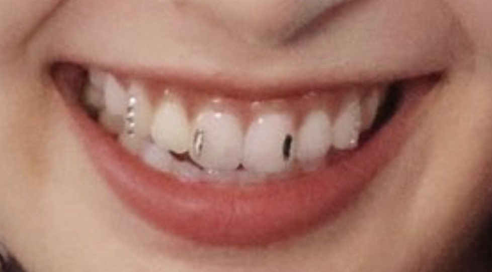 hinata’s tooth gems 🦷💎 tweet media
