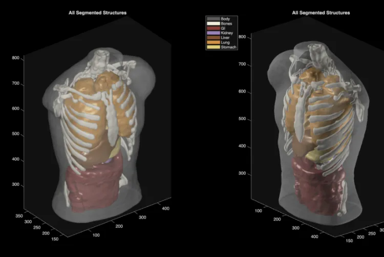 rohanpaul_ai's tweet photo. Midjourney's massive pivot  into the personal health and medical industries.

Its first hardware project, a scanner that reads your body in 60 seconds, with 'full-body ultrasound machine'.

The plan is to put people in water, lower them through a sensor ring, send ultrasound waves through the body from many angles, record how those waves bend and scatter through fat, muscle, bone, and organs, then reconstruct a 3D internal map rather than a normal flat ultrasound view.

The water matters because ultrasound travels cleanly through it, so the body can be scanned from all sides without a handheld probe pressing against one spot.

Midjourney says the system uses 40 Butterfly Ultrasound-on-Chip modules, thousands of transducers, and about two petaflops of processing to reconstruct 3D maps of muscle, fat, bone, and organs in about 60 seconds.

This is closer to ultrasound CT than hospital CT, because it uses sound waves instead of ionizing radiation, and it avoids MRI’s strong magnets.

Midjourney’s first target is not cancer diagnosis or organ-disease detection, but body composition maps, meaning repeatable scans that show changes in muscle, fat, bone, organs, and possibly training or diet effects.

Medical diagnosis would need FDA clearance, so the likely path is wellness first, then narrow medical claims one by one, rather than a finished hospital-grade MRI replacement on day 1.

The first public site is planned for San Francisco by end-2027, inside a Midjourney Spa with about 10 scanners, hot tubs, saunas, cold plunges, and a gym.

Midjourney says the bigger target is 50,000 scanners globally over 6 years and 1B full-body scans per month, but that is still a company ambition, not a proven deployment plan.

What is happening here is a bet that medical imaging becomes less like a rare test and more like a longitudinal record of the body