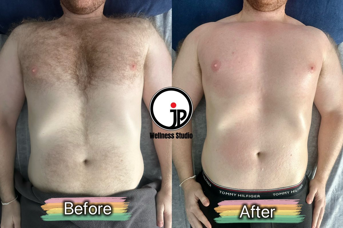 JP__wellness's tweet photo. Customer from Greece 🇬🇷 came for body hair removal😍. Come and start your waxing journey with us!
Male Therapist, by appointment only 📲 WhatsApp (+6012-3257857)
#boyzilianwax #healthymanhood #hotwaxingspecialist #hotwaxingformen #maletherapist #hairremoval #phwaxing #jpws https://t.co/rLNQYzYlVA