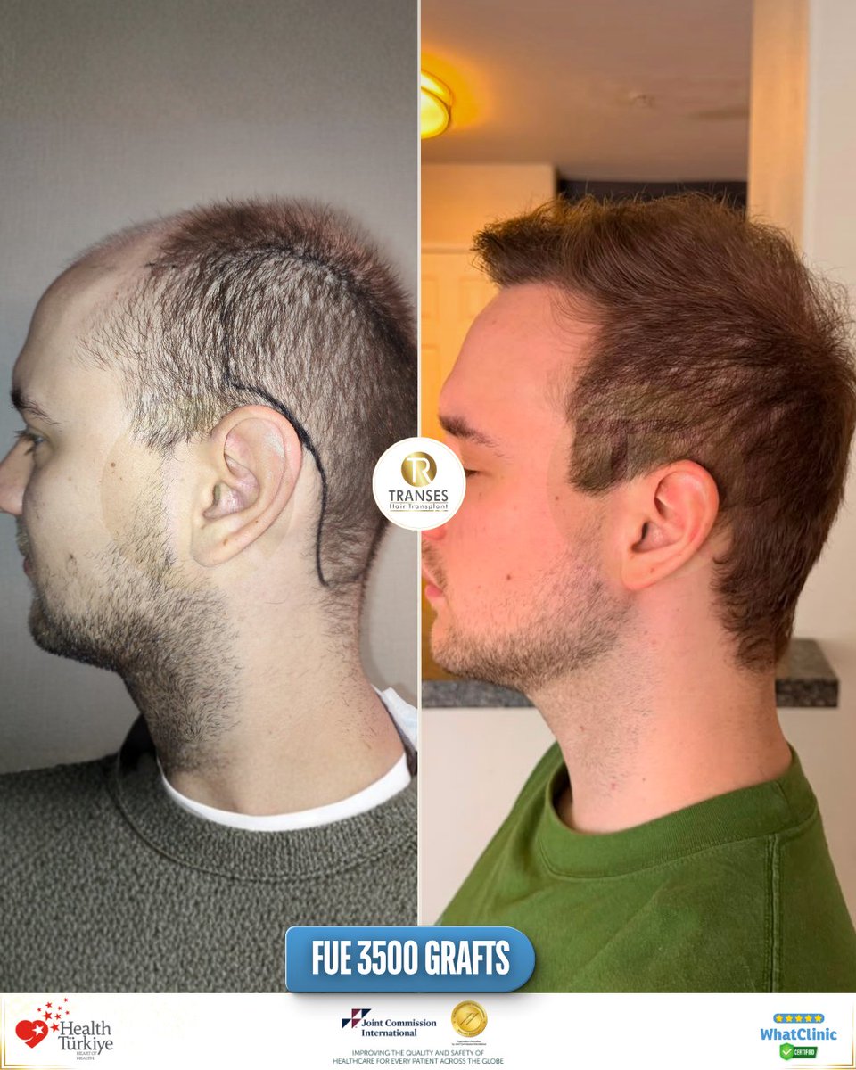transeshair's tweet photo. This hair transplant operation was performed at Istanbul Tema Hospital BHT Clinic.
15 years of experience with a 4.9 ⭐ WhatClinic rating.
FUE • DHI • HYBRID • PRP
Natural results, professional care.

#YourJourneyYourTransformation
#TransesHairTransplant
#FUE #DHI #PRP https://t.co/kczW0Vjd1h