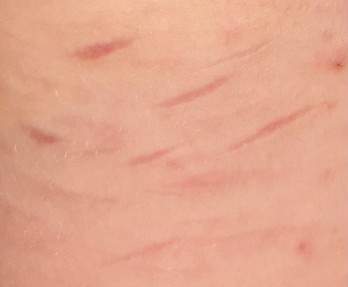 deeznunchuckles's tweet photo. some of my favorite scars because i'm waiting for a sharp enough blade #shtwt #slittwt https://t.co/9T4gGFEiez