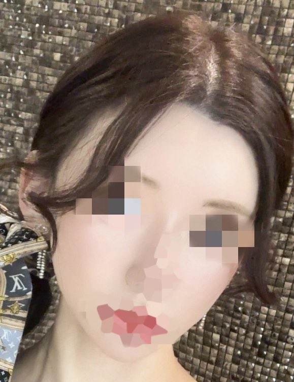 mii__3838's tweet photo. ジャスト美容外科でエッグリフトをしてから1ヶ月が経ちました！🌈悩みだった輪郭3点後の口横のもたつきが解消されて全体的に引きあがって満足しています🫶✨もっと早くやればよかったと思いました🥹次もここでやろうと思います！
小顔になって他撮りも盛れます🎶
ヤン院長に施術してもらいました🎀🙏 https://t.co/7grfsO3b9H