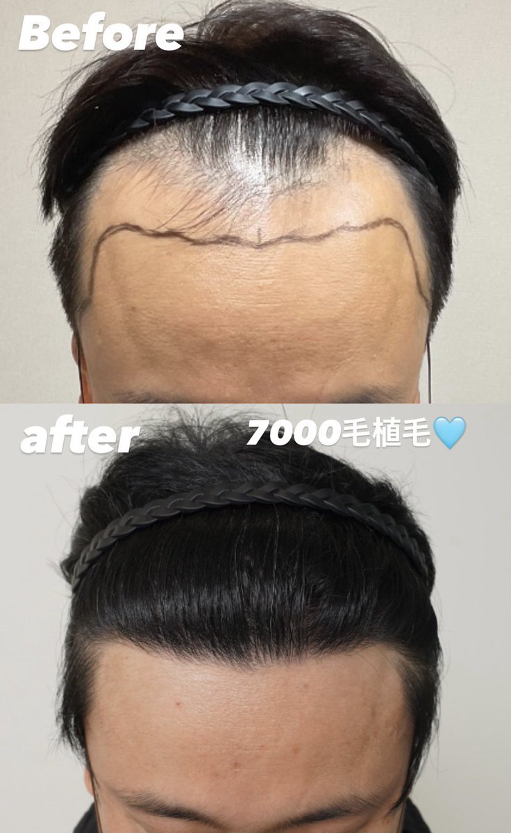 ParamiClinic's tweet photo. 韓国植毛・額縮小専門パラミクリニックです🏥

【植毛】

移植毛数：7000毛
採取方法：切開(FUT)+非切開(FUE)混合
経過：術後1年

深いM字と密度の落ちたヘアラインを改善✨

#植毛　#植毛専門医 #植毛経過 #パラミクリニック
#韓国植毛専門クリニック 

https://t.co/HQfbPdkjKv https://t.co/j8dKipKWgz