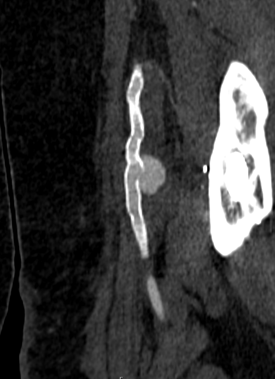 ItaniMalak's tweet photo. Case #19 in 2026 

Ever seen a fractured stent??!!
 
#MedEd #rad #radiology #vascular #VIR #imaging https://t.co/afg7JIwQV6