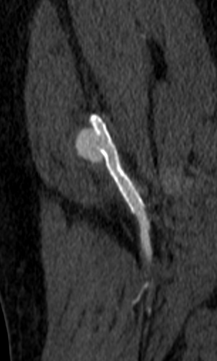 ItaniMalak's tweet photo. Case #19 in 2026 

Ever seen a fractured stent??!!
 
#MedEd #rad #radiology #vascular #VIR #imaging https://t.co/afg7JIwQV6