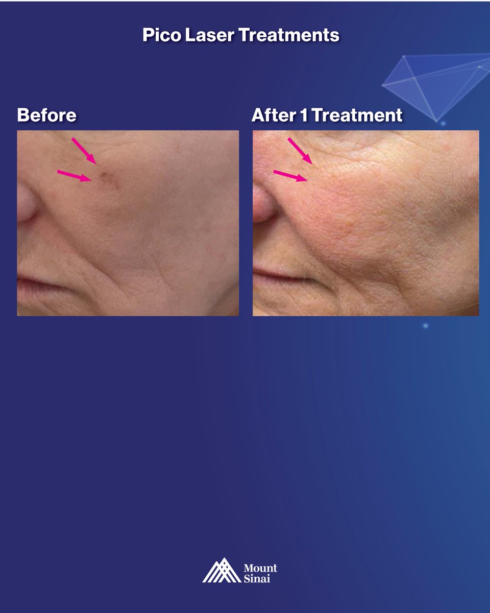 Mount Sinai Dermatology tweet media
