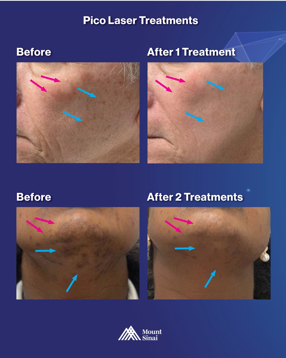 Mount Sinai Dermatology tweet media