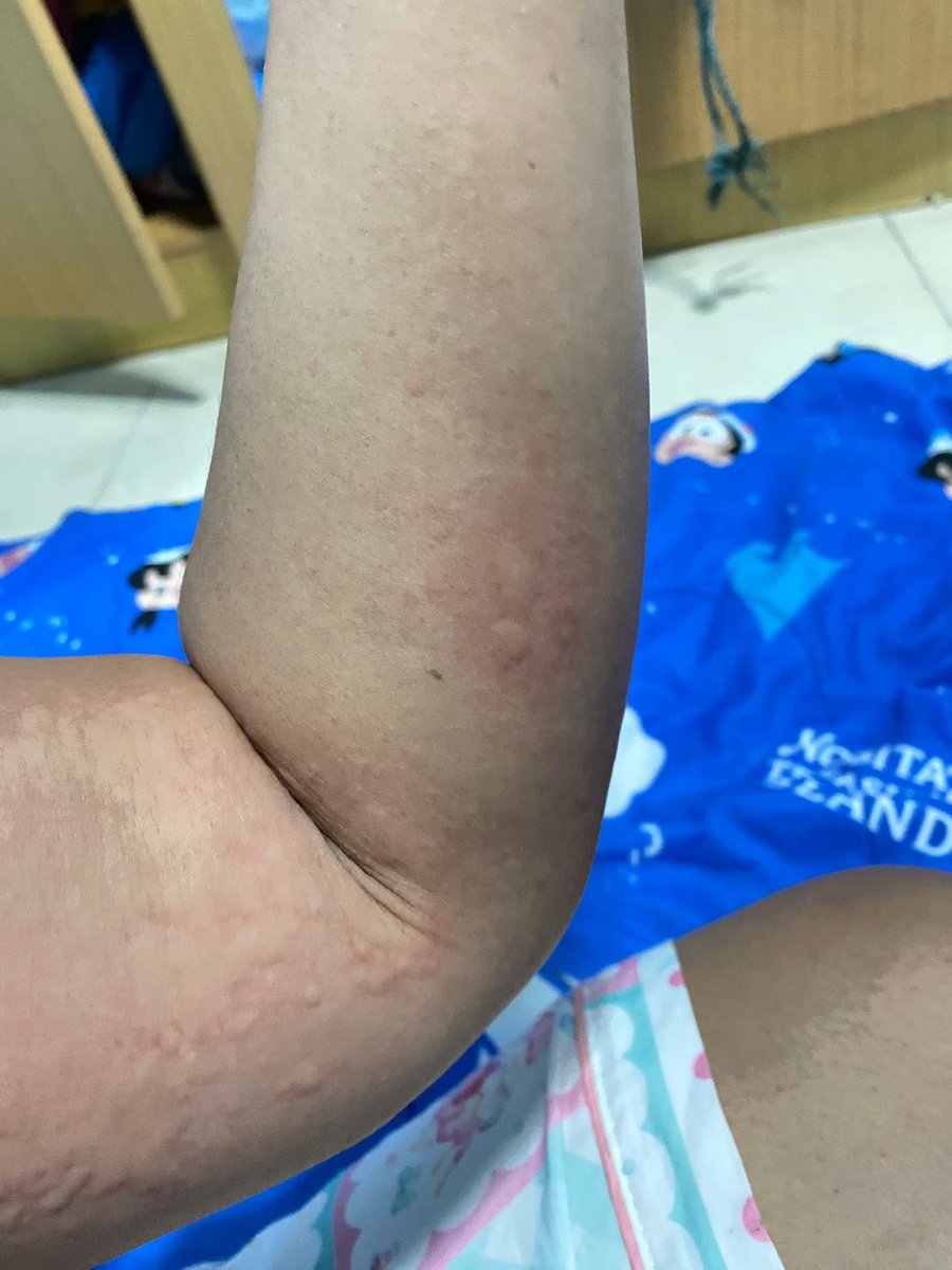 Oomim_11's tweet photo. 🔥ภูมิตก (ภูมิคุ้มกันตก) คือ ภาวะที่ระบบภูมิคุ้มกันของร่างกายทำงานได้ไม่เต็มประสิทธิภาพ ส่งผลให้ร่างกายอ่อนแอ ต่อสู้กับเชื้อโรค ไวรัส หรือสิ่งแปลกปลอมได้ลดลง ทำให้เจ็บป่วยง่าย เป็นหวัดเรื้อรัง และฟื้นตัวช้ากว่าปกติ 🥺

สัญญาณเตือนเมื่อภูมิตก
คุณอาจกำลังเผชิญภาวะนี้หากมีอาการดังต่อไปนี้:
•ป่วยบ่อย: เป็นหวัด เจ็บคอ ท้องเสีย หรือติดเชื้อซ้ำซ้อนบ่อยๆ
•อ่อนเพลียเรื้อรัง: เหนื่อยง่าย รู้สึกหมดเรี่ยวแรงแม้จะพักผ่อนเพียงพอ
•แผลหายช้า: บาดแผลหรือรอยฟกช้ำตามร่างกายใช้เวลานานกว่าปกติกว่าจะหาย
•ผิวหนังผิดปกติ: มีอาการคัน เป็นผื่น หรือติดเชื้อที่ผิวหนังได้ง่าย
•ปัญหาระบบย่อยอาหาร: ท้องอืด หรือมีปัญหาลำไส้บ่อย

🍀เราเป็นตั้งแต่วันที่ 25 กุมภาพันธ์- 22 มีนาคม 2569 ซึ่งเป็นระยะเวลาที่ทรมานมากในชีวิตนี้ 2 อาทิตย์แรกคือคันมากคันจนนอนไม่ได้ทำอะไรไม่ได้เลยหาหมอก็ไม่หาย ทายาก็ไม่หาย กินยาก็ไม่หาย ฉีดยาก็หายได้ประมาณ 30 นาทีก็กลับมาคันใหม่ยิ่งเกายิ่งขึ้นลามไปเรื่อย แล้วยิ่งทายาไปนานๆ ก็มีอาการผิวแห้งเข้ามาร่วมด้วยเราเลยตัดสินใจ เราจึงจะตัดสินใจซื้อเซวีมาทา ปรากฏว่าอาการดีขึ้นพอผิวเริ่มไม่แห้งอาการคันก็ไม่หนักเหมือนเดิมแต่ก็ยังไม่หายขาดจนตัดสินใจไม่เอาอะไรเลยพักผ่อนเต็มที่อย่างเดียวให้แฟนหยุดงานมาดูลูกช่วยพอได้นอนเต็มอิ่มประมาณสามสี่วันอาการก็หายเป็นปกติ 🍀🌈

❤️สาเหตุหลักที่เราเป็นเลย⁉️คือพักผ่อนน้อย ถือว่าน้อยมากเพราะต้องเลี้ยงเบบี๋เอง 2 คน กว่าจะมีคนช่วยก็หลังเวลาเลิกงาน 5 โมงเย็น  ต้องทำทุกอย่างเองหมด กว่าจะเสร็จบางวันก็เที่ยงคืนบางวันก็ตี 1 ตอนเช้าก็ต้องตื่นแต่เช้าหรือบางวันลูกตื่นก็ต้องตื่นตามลูก  ตอนกลางวันนี่ยิ่งไม่ต้องพูดถึงเลยไม่เคยได้นอนเลย หรือบางวันดีหน่อยได้งีบตามรูปซัก 10 20 นาทีนั่นคือสวรรค์มากๆเลย ☺️

✨แค่อยากจะมาแชร์เตือนประสบการณ์ใครที่กำลังรู้สึกว่าตัวเองป่วยบ่อย ภูมิตก ให้รีบไปปรึกษาแพทย์ และพักผ่อนเยอะๆ นะคะ เพราะมันทรมานมาก ตอนที่เราเป็นไม่ได้มีแค่ผื่นคันแต่มีอาการอื่นร่วมด้วยตามที่กล่าวข้างบนเลย✨ 

ช่วงนี้อากาศเปลี่ยนแปลงบ่อยด้วยขอให้ทุกคนดูแลสุขภาพตัวเองด้วยนะคะ😍