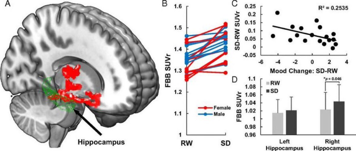 AntelmPujol's tweet photo. 🚩🚩Dormir poco aumenta el riesgo de Alzheimer.

📌 1 sola noche sin dormir eleva la carga de β-amiloide en el cerebro hasta un 5% en el hipocampo y tálamo.

📌 Dormir <6 h/noche se asocia con más acumulación de β-amiloide en regiones clave.

🫡Cuidar nuestro descanso no es opcional.