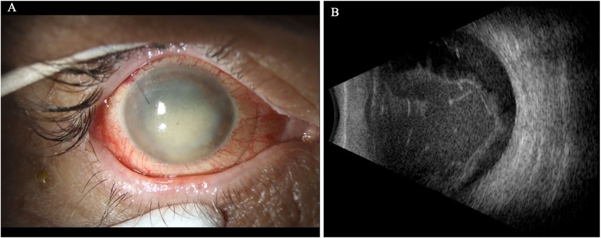 lrohowetzmd's tweet photo. Grateful to have contributed to this newly published study on Staphylococcus warneri endophthalmitis.

Among 8 culture-proven cases:
🔹100% vancomycin susceptibility
🔹Most followed injection or surgery
🔹86% ultimately required vitrectomy

Link: https://t.co/rPMd6zqceB https://t.co/p4Rl7FaI4y