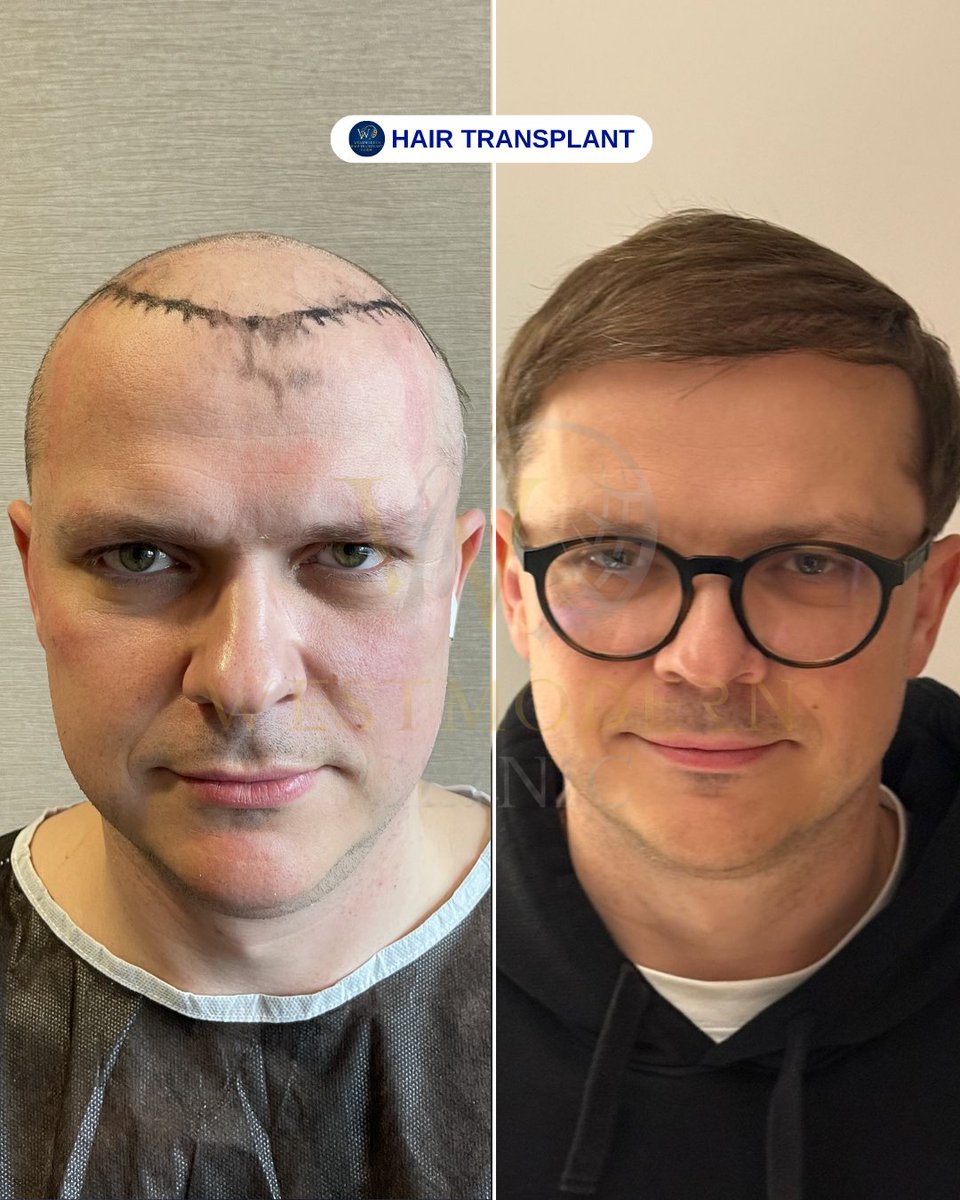 WestModernTR's tweet photo. “With West Modern Clinic, enjoy natural and stylish hair for every look! ✨💇‍♂️💇‍♀️🌿”

“West Modern Clinic ile her tarza uygun, doğal ve sağlıklı saçlara sahip olun! ✨💇‍♂️💇‍♀️🌿”

WEST MODERN CLINIC &amp; HAIR TRANSPLANT IN ISTANBUL/TURKEY

#hairtransplantturkey https://t.co/ZsqGLMIWd3