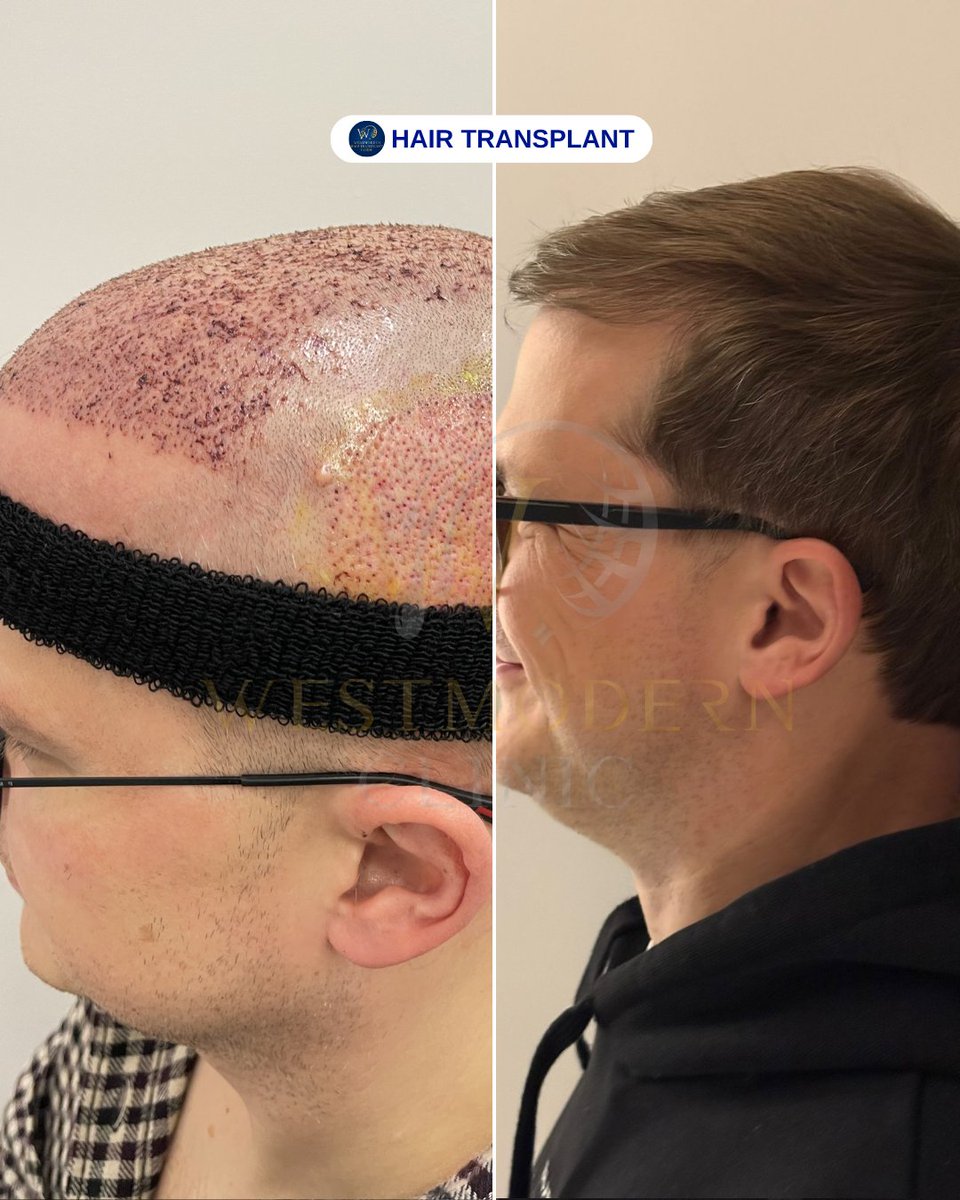 WestModernTR's tweet photo. “With West Modern Clinic, enjoy natural and stylish hair for every look! ✨💇‍♂️💇‍♀️🌿”

“West Modern Clinic ile her tarza uygun, doğal ve sağlıklı saçlara sahip olun! ✨💇‍♂️💇‍♀️🌿”

WEST MODERN CLINIC &amp; HAIR TRANSPLANT IN ISTANBUL/TURKEY

#hairtransplantturkey https://t.co/ZsqGLMIWd3