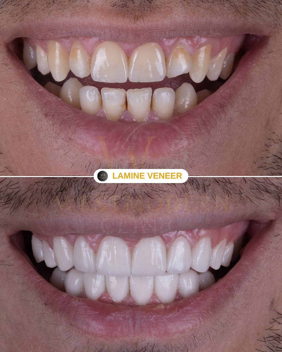 WestModernTR's tweet photo. After thoroughly evaluating our patient’s oral and dental health 🧑‍⚕️🦷, we decided to restore their smile by applying zirconium crowns to all teeth ✨. Thanks to zirconium’s ability to mimic the natural appearance of teeth, we achieved both a brilliant shine 😁 and perfect harmony with the patient’s facial features.

Each tooth was meticulously designed to suit the patient’s face shape, skin tone, and smile line 🎨🖌️. With this personalized and careful approach, our patient now enjoys the radiant and aesthetic smile they’ve always dreamed of 🌟💫

Now, they can smile with confidence and joy 😍🙌
Wishing you a lifetime of happiness and health with your brand-new smile! 💖👄

Hastamızın ağız ve diş sağlığını detaylı bir şekilde değerlendirdikten sonra, estetik ve fonksiyonel ihtiyaçlarını göz önünde bulundurarak tüm dişlerine zirkonyum kaplama uyguladık 🦷✨ Zirkonyumun doğal diş görünümüne en yakın materyal olması sayesinde, hem doğal bir parlaklık 😁 hem de mükemmel bir uyum elde ettik.

Her bir diş, hastamızın yüz şekline, ten rengine ve gülüş hattına uygun olarak özel olarak tasarlandı 🎨🖌️. Bu titiz ve kişiye özel çalışma sonucunda hastamız, hayal ettiği ışıltılı ve estetik bir gülüşe kavuştu 🌟💫

Artık kendinden çok daha emin bir şekilde gülümseyebiliyor 😍🙌
Yeni gülüşünüz sağlıkla ve mutlulukla kullanmanız dileğiyle! 💖👄

WEST MODERN CLINIC & HAIR TRANSPLANT IN ISTANBUL/TURKEY

#lamineveneer