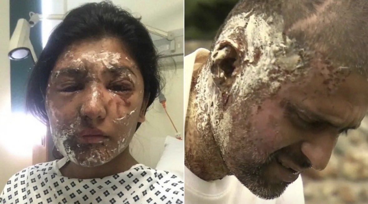uk_islamophobia's tweet photo. Acid was thrown on a Muslim woman and man.

Resham Khan. 21st birthday. Beckton, East London. 21 June 2017.

She and her cousin Jameel Mukhtar were stopped at a red light.

A man walked up.
He threw sulphuric acid through the passenger window, then ran around and threw more through the driver's window.

They crashed. Stripped in the street. Begged for water for 45 minutes.

Resham lost the use of one eye. Lifelong facial scars. She has tried to take her own life.
Jameel was put in an induced coma. Lost hearing in one ear. He told doctors: "I just want to die."

Police initially said no religious motive. They reopened after the family went public. The prosecution still did not pursue it as a hate crime. The judge called it "somewhat random."

That was 2017.

2 August 2025. Bedminster, Bristol.

Alina Burns, 18, walked up behind Mohammed Mahmoodi, a Kurdish-Iranian barber who fled Iran. She swung an axe at his neck. He survived because he ducked.

Five months earlier she had emailed: "Kill all Jews and Muslims in Britain, please."

Police found Telegram contact with Patriotic Alternative. The Turner Diaries. A terrorist handbook. An email titled "The dawn of civil war."

Sentenced: 19½ years. Terrorist connection.

MI5: 25% of the UK counter-terror caseload is extreme right-wing. The Director General says this "skews heavily towards young people."

Burns was 18. Radicalised on Telegram. Connected to Patriotic Alternative.

Antisemitism is real. When the state names it, the response is what it should be.

Golders Green, April 2026: PM on site. Threat level raised to severe. £25m security funding.

Bristol, August 2025: No COBRA. No PM statement. No threat level review. No funding. No statement from the local MP.

Same country. Different response.

And now Rupert Lowe has linked grooming gangs to Islam. Every Muslim in this country has just been made a target by that framing.

And yet the Government will not call it Islamophobia. It says "anti-Muslim hostility." A definition that "focuses on Muslims rather than Islam as a religion."

The community most affected does not get to name what is happening to it.

Muslim Women's Network UK, cited in HC 571: before the 2024 riots, 16% of Muslim women feared for their safety. After: 75%.

MI5 has named the threat. The state has not matched it.

So we name it. Every attack. Every refusal. On the record.

Report: https://t.co/D9amGp2yxO
Keep us alive: https://t.co/Z8H0Flg44Y
Substack: https://t.co/9x6sqmwMge

Sources in first comment.