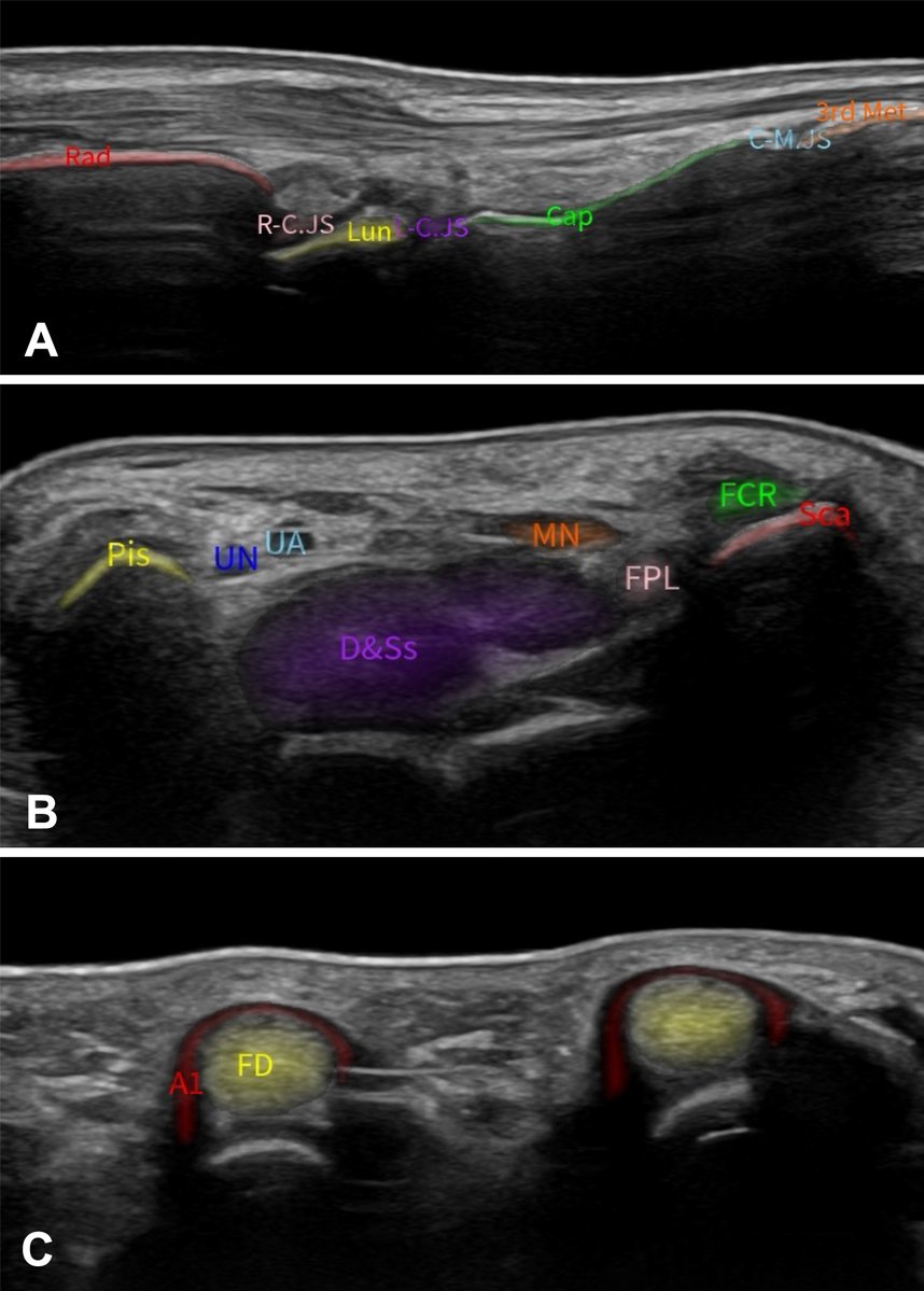 radiology_rsna's tweet photo. Drs. @XinyiTang_WCH, Yang, and colleagues developed an AI-based tool that improves image acquisition in standard planes and imaging efficiency among junior novice practitioners of dynamic wrist-hand US. @IHuaXi https://t.co/1cUNZr02tX https://t.co/NAPUx5V6KY