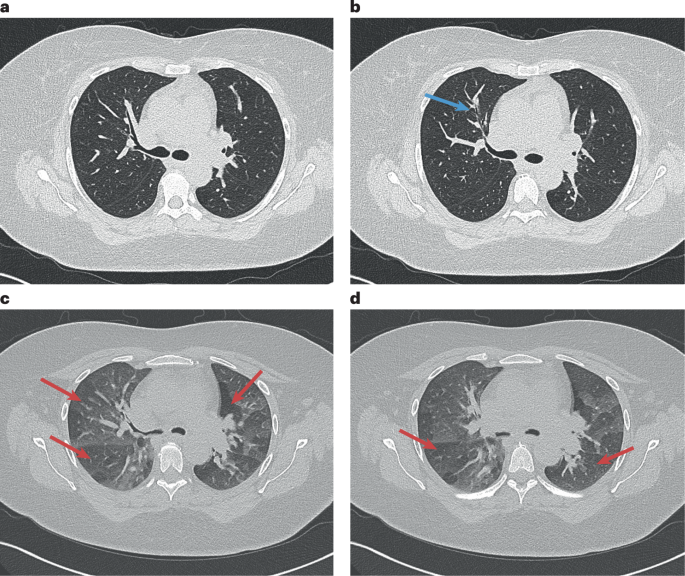 NatRevRheumatol's tweet photo. New content online: Lung disease in rheumatoid arthritis https://t.co/m2QSlSPR9R https://t.co/r6M7I3spg8