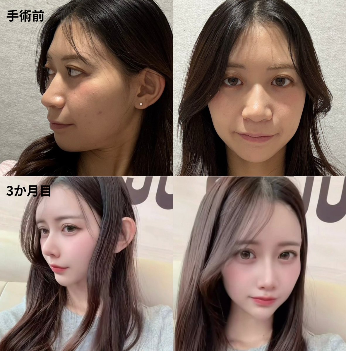 lij8hd's tweet photo. 【　術後3か月　】

1番の変化は、病院症例写真での理想通り横顔が綺麗になりました☺️

日常生活での不便さ特に無いです

鼻をぶつけないよう気をつけていたり、
上向きで寝たりといった注意は続けていますが、痛みも全くなく、手術部位を意識する事なく過ごせています💭

#グナル美容外科 https://t.co/mavH82Zhjf