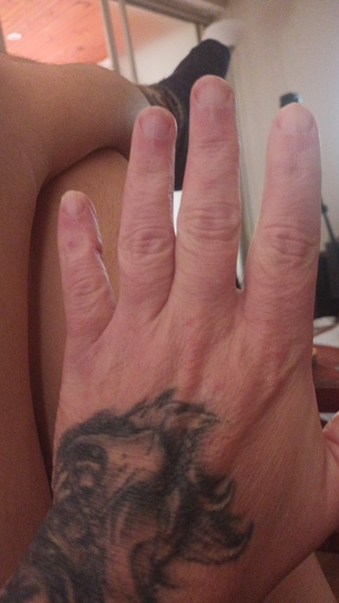 NicholasAG72's tweet photo. Normal hand (L).

Swollen hand (R).

Lesson : when weeding the garden wear gloves.

Nettles lurk among the dandelions. https://t.co/srxELRRKlB