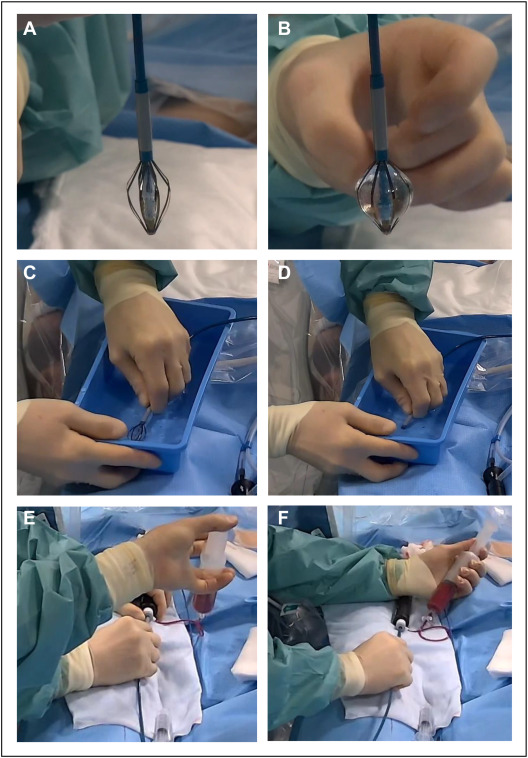 HRS_O2Journal's tweet photo. Pulmonary vein isolation using a novel balloon-in-basket pulsed field ablation system: The Lübeck how-to protocol, by @PerWenzel and colleagues
@UKSH_KI_HL @dzhk_germany #EPeeps
https://t.co/Vv3JsYNrru https://t.co/J3ecK2JJRv