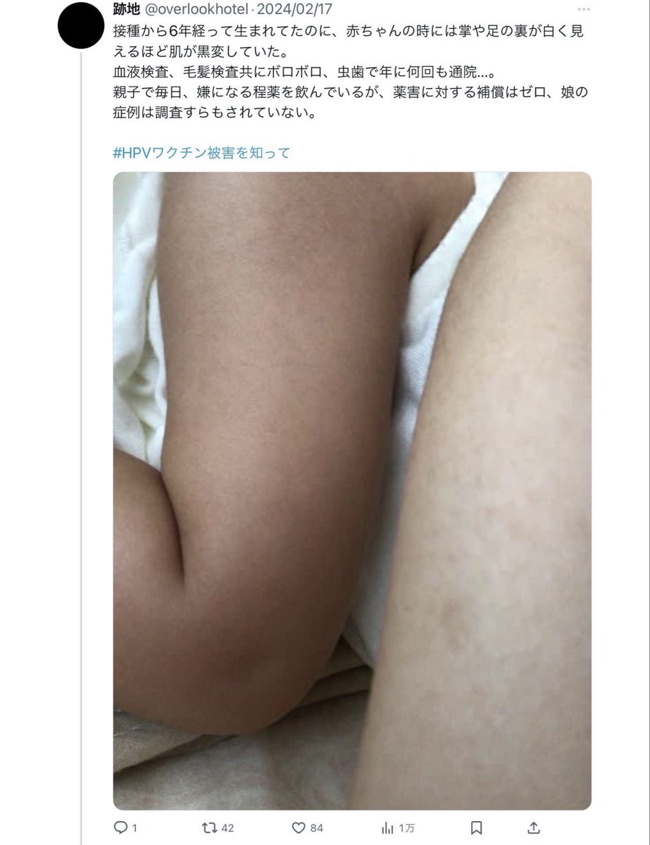 Gfullofstars's tweet photo. はじめまして。
私はHPVワクチンを打って子宮頸がんになり、8人の子どもを流産し、やっと生まれてきた子どもも真っ黒、今は重度障害者になってしまった者です。

国内外で私と同じようにHPVワクチンを打ち、子宮頸がんになったり、死んでいる子達がいます。

さちみりほ先生がご指摘のBBCの記事で引用されている論文著者には利益相反があります。

どうか被害者をよく見られてから、HPVワクチンの真実をお伝えください。
よろしくお願い致します🙇‍♀️