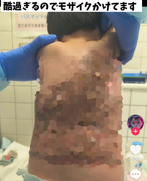 aigare01's tweet photo. 【悲報】ママさんが入院のため
1歳児を児相経由で里親に預けるも
（他人が期間限定で子どもを預かる制度）
３日後、背中に大火傷を負って緊急搬送1ヶ月入院

里親いわく
「鍋をひっくり返して熱湯がかかった」
救急車呼んだのは30分後
しかも謝罪なし

これ、慰謝料取れないの？
里親登録抹消もんだろ https://t.co/1gr3kTb1XX