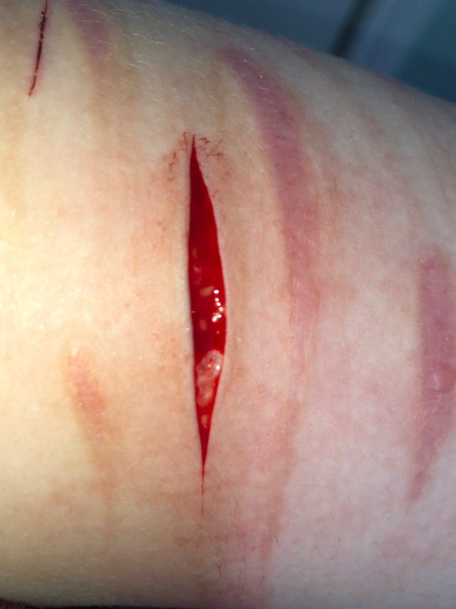 W1nchest3rr's tweet photo. #shtwt brodie hit beans 😱😱
Ouu shii baby baby beans w/ da bois @ewwPancakes_ sorry for the low quality
#shtwt #slittwt #bbbeans #styros #selfharmtwt #selfharm https://t.co/sN5WJXzJMH